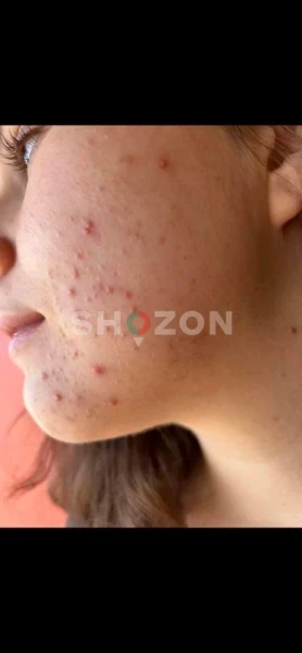 Maonas Acne &  Darkspots Cream